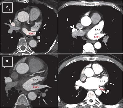 Frontiers Left Atrial Anatomical Variations Correlate With Atrial